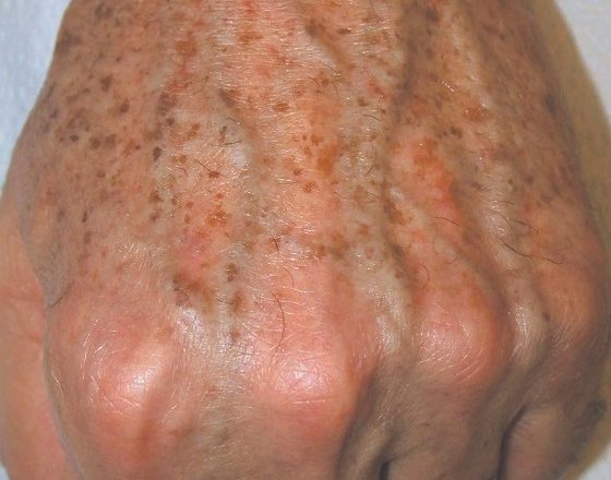 Знаете ли вы, что появление пятен на руках может быть явным признаком того, что…