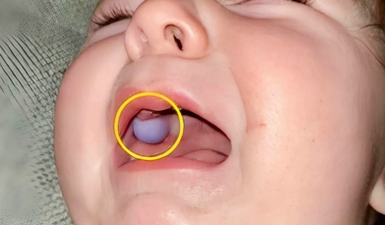 Мать заметила во рту своего девятимесячного малыша нечто пугающее и сразу повезла его к врачу. То, что специалисты обнаружили во рту ребёнка, привело всех в настоящий ужас