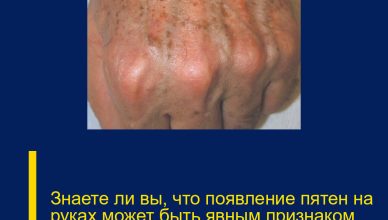 Знаете ли вы, что появление пятен на руках может быть явным признаком того, что…