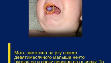 Мать заметила во рту своего девятимесячного малыша нечто пугающее и сразу повезла его к врачу. То, что специалисты обнаружили во рту ребёнка, привело всех в настоящий ужас Мать заметила во рту своего девятимесячного малыша нечто пугающее и сразу повезла его к врачу. То, что специалисты обнаружили во рту ребёнка, привело всех в настоящий ужас