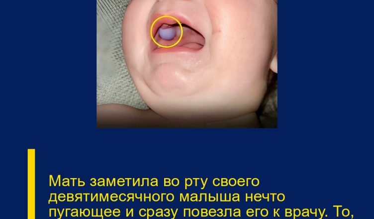 Мать заметила во рту своего девятимесячного малыша нечто пугающее и сразу повезла его к врачу. То, что специалисты обнаружили во рту ребёнка, привело всех в настоящий ужас
